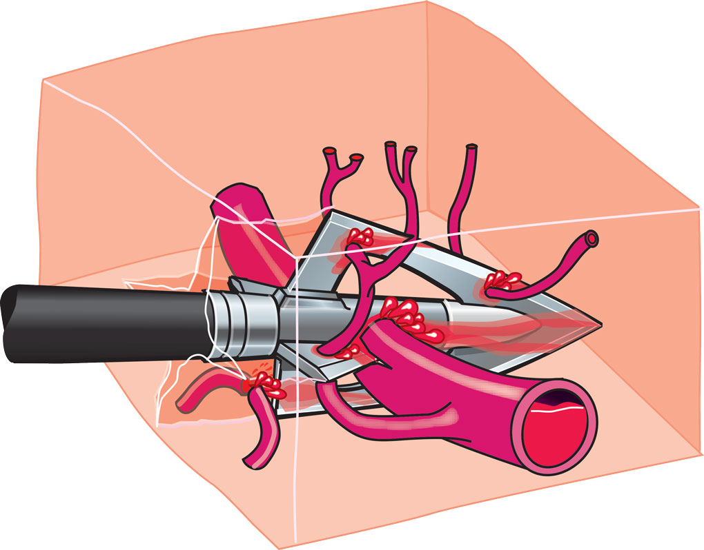 A broadhead piercing arteries and veins